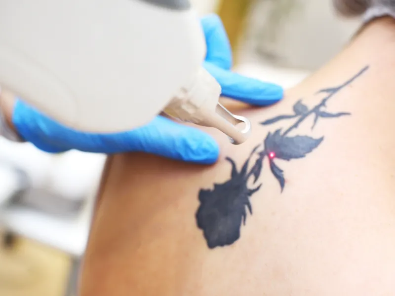 Picosecond Laser Tattoo Removal