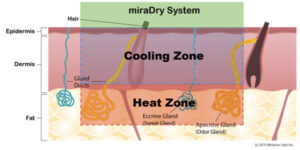 Miradry Diagram1