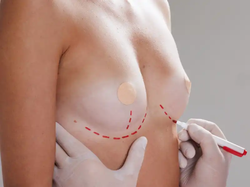 Fat Grafting For Body