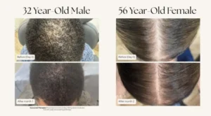 Xtressé™ Xvie Hair Restoration 1 Xvie Before &Amp; After